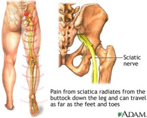 sciatic-nerve-sciatica-pain-down-the-leg-low-back-pain-chiropractic